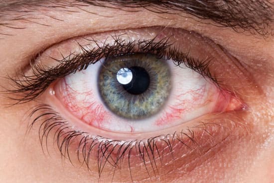 Кровоизлияние в глаз: лечение