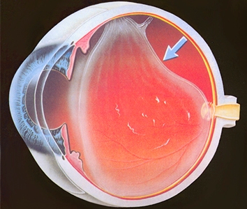 Отслоение сетчатки глаза: симптомы и лечение